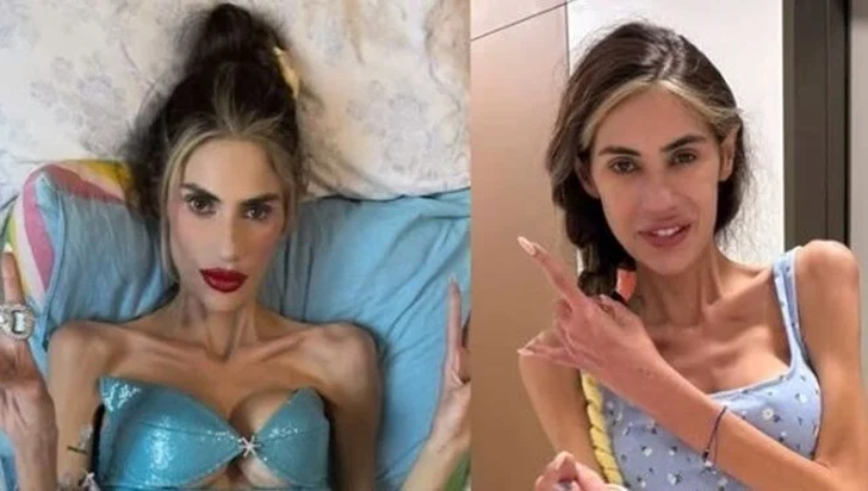 Anoreksiya nervoza rahatsızlığı nedeniyle 25 kilonun altına düşen sosyal medya